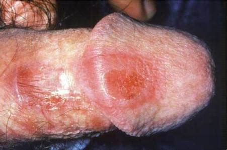 Penile Rashes Sexual Health And Genital Medicine In Clinical Practice