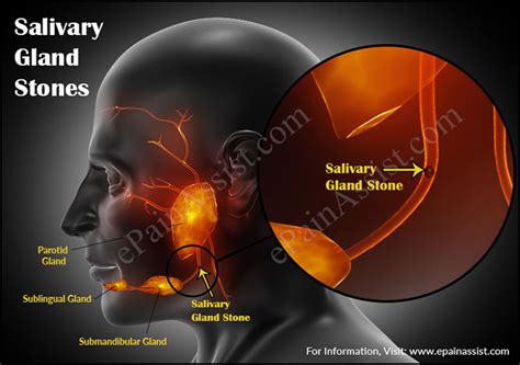 Causes Of Salivary Gland Stones And Its Treatment Home Remedies