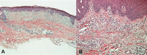Parakeratosis And Mild Spongiosis In The Epidermis As Well As