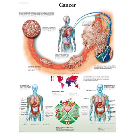 3b Scientific Cancer Chart