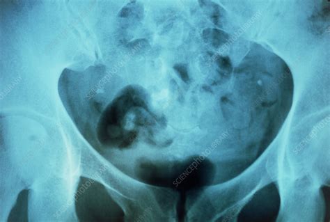 X Ray Of A Pelvis Showing Dermoid Cyst With Tooth Stock Image M130