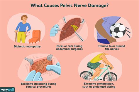 Overview Of Pelvic Nerve Pain