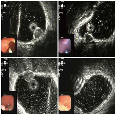 Diagnostic Accuracy Of Endoscopic Ultrasonography For Rectal Neuroendocrine Neoplasms