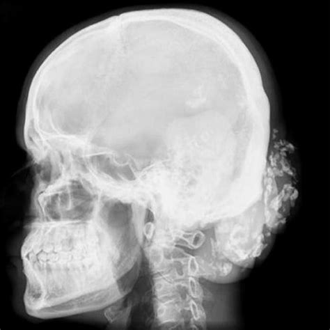 Right Occipital Region Showing Two Of The Largest Swellings On The