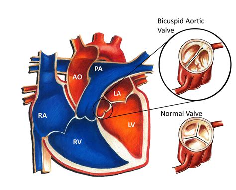 Exercise Restrictions With Bicuspid Aortic Valve Online Degrees
