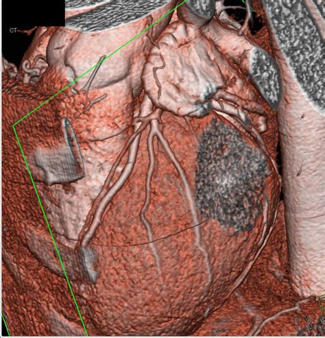 Ccta Left Anterior Descending Coronary Artery Lad With Result Of