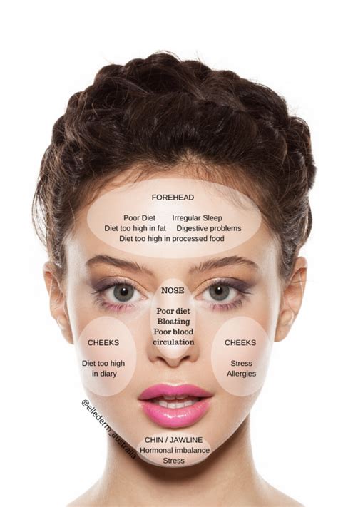 Face Mapping Acne Natural Acne Treatment Acne Breakout Face Acne Hormonal Acne Prevent Acne