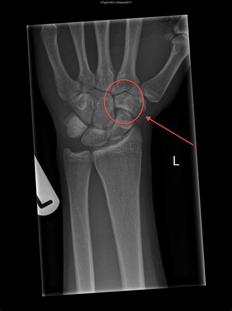 Dorsal Dislocation Of The Trapezoid With Carpo Metacarpal Dislocations