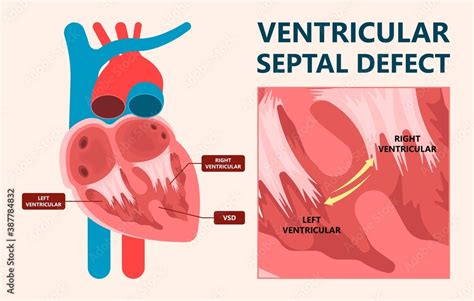 Cath Lab Atrial Septal Defect Tetralogy Of Fallot Patent Foramen Ovale