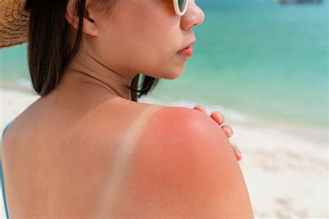 Heres What Happens To Your Skin When You Get A Sunburn Baton Rouge