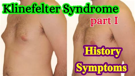 klinefelter syndrome part i history symptoms genetic disorders in humans youtube