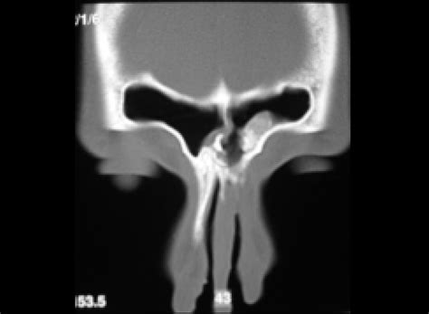 Aspecto Tomográfico Pós Operatorio De Osteoma Frontoetmoidal