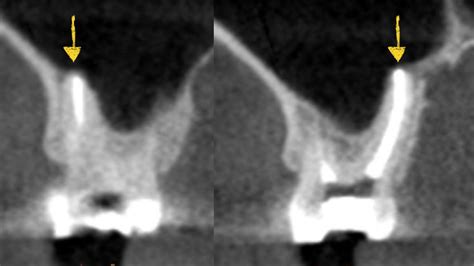 Upper Jaw Sinus Perforation Following A Tooth Extraction Upper Jaw Sinus Perforation Following