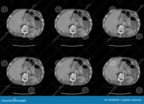 Computed Tomography Ct Whole Abdomen In Axial Part Fifteen Stock Photo