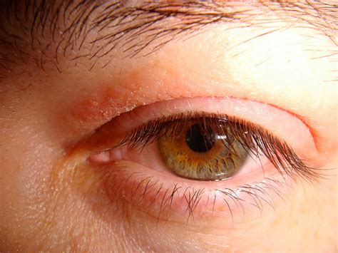 Eyelid Rash Pictures Causes Symptoms And Treatment