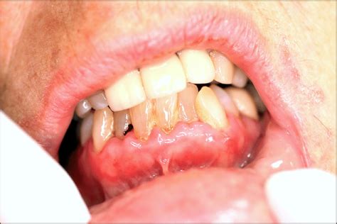 Painful Ulcer On The Right Ventral Tongue With Irregular Margins