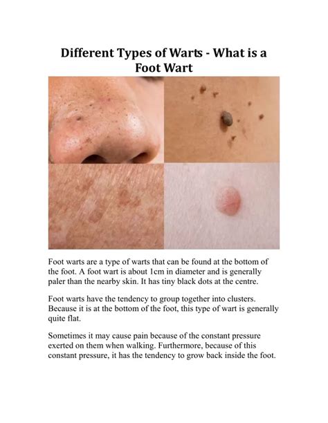 PPT Different Types Of Warts What Is A Foot Wart PowerPoint