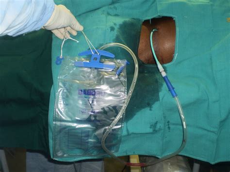 Ramayya Pramila Urology Hospital Percutaneous Nephrostomylife Saving