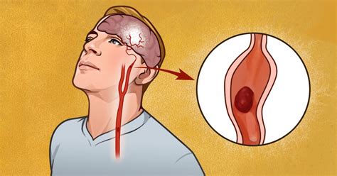 7 Early Warning Signs Of Stroke Everyone Should Know 99easyrecipes