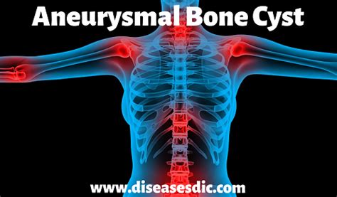 Aneurysmal Bone Cyst Abc Definition Causes And Treatment