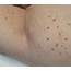 Lumps And Bumps  Faciem Dermatology Clinic