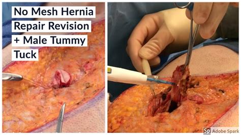 Dr Repta Performs A No Mesh Ventral And Umbilical Hernia Repair