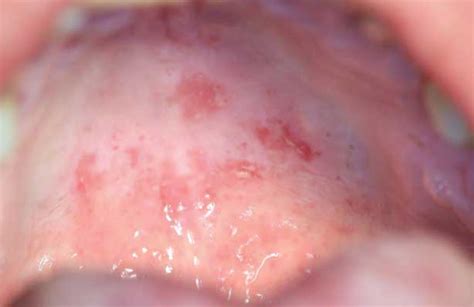 Multifocal Oral Candidiasis With A Rare ‘kissing Lesion Decisions In Dentistry