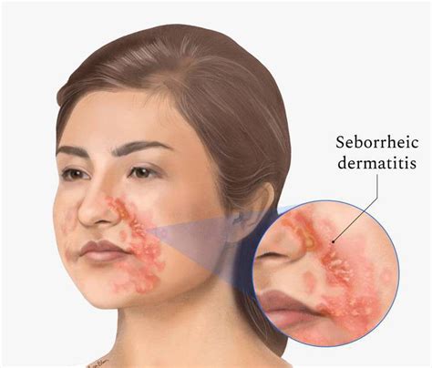 Seborrheic Dermatitis Medizzy