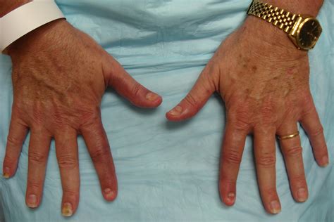 A Rare Case Of Idiopathic Neutrophilic Dermatosis Of The Hands