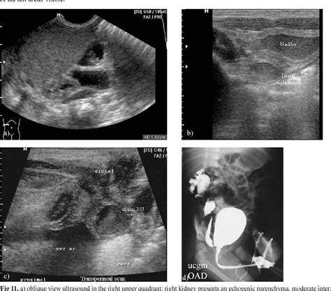 Figure 11 From The Role Of Ultrasonography For Diagnosis The Renal