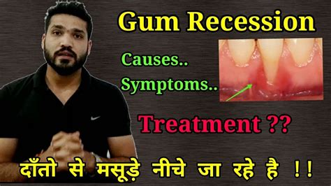 Gum Recession Causes Symptoms Treatment How To Identify Receding
