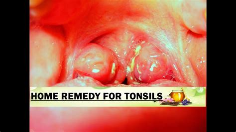 Home Remedy For Tonsils Ii टॉन्सिल्स का घरेलू उपचार Youtube