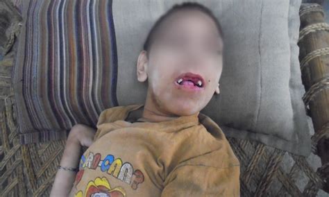 The same equation can continue for fourth cousins, fifth cousins, and so on. Deformities in Charsadda: Cousin marriages, and the heavy ...