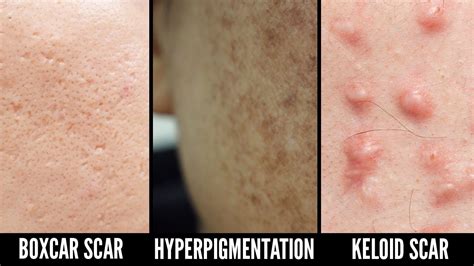 How To Effectively Treat Acne Scars And Hyperpigmentation Youtube