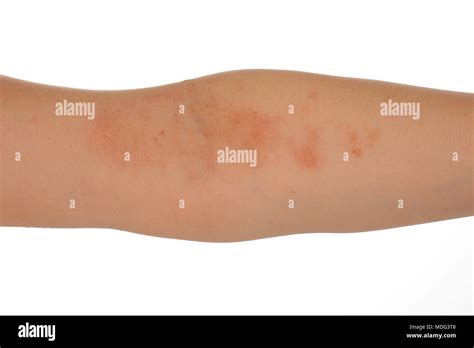 Dermatitis Eccema En La Piel Del Brazo De La Mujer Aislado Sobre Fondo