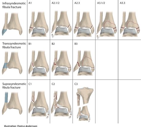 The Aoota Classification Of Ankle Fractures Download Scientific Diagram