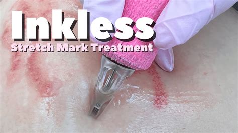 Inkless Camouflage Stretch Mark Treatment Youtube