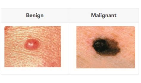 Skin Cancer Symptoms The Difference Between Normal And Cancerous Moles