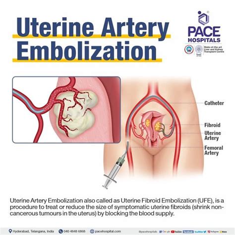 Uterine Artery Embolization For Postpartum Hemorrhage