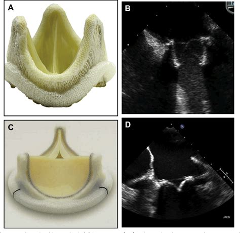 Figure 9 From Mitral Prosthetic Valve Assessment By Echocardiographic