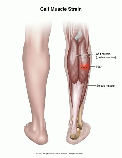 The Gallery For Soleus Muscle Strain
