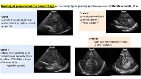 Grading Of Germinal Matrix Hemorrhage In Us 8 Download Scientific