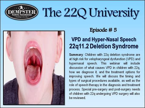Digeorge syndrome, or chromosome 22q11.2 deletion syndrome, is a disorder affecting multiple organ systems. 22Q University Episode #5 "VPD and Hyper-nasal Speech ...