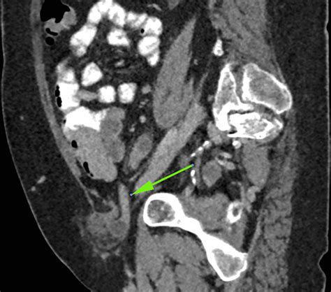 Ct Scan Sagittal Section Right Obturator Hernia 948