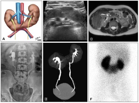 Beautiful Multi Modality Imaging Of A Horseshoe Kidney