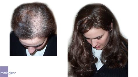 Trichotillomania Or Compulsive Hair Pulling Before And After London Hair Integration