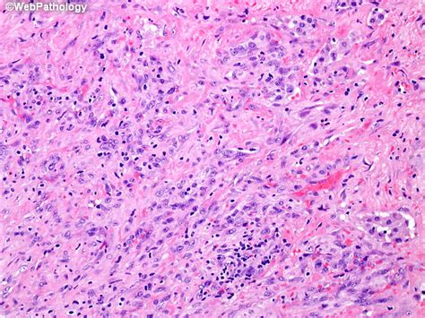 About 600 cases are diagnosed each year in the united. Webpathology.com: A Collection of Surgical Pathology Images