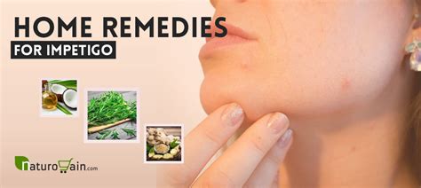 11 Best Home Remedies For Impetigo To Prevent Skin Infection