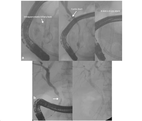 Ercp And Biliary Stenting Cholangiography Confirmed An Intrapancreatic