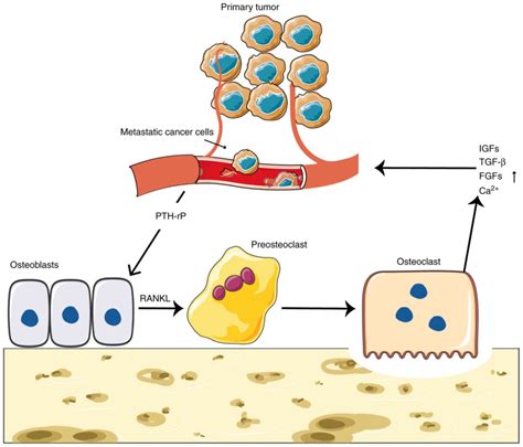 Role Of Tumor‑derived Exosomes In Bone Metastasis Review